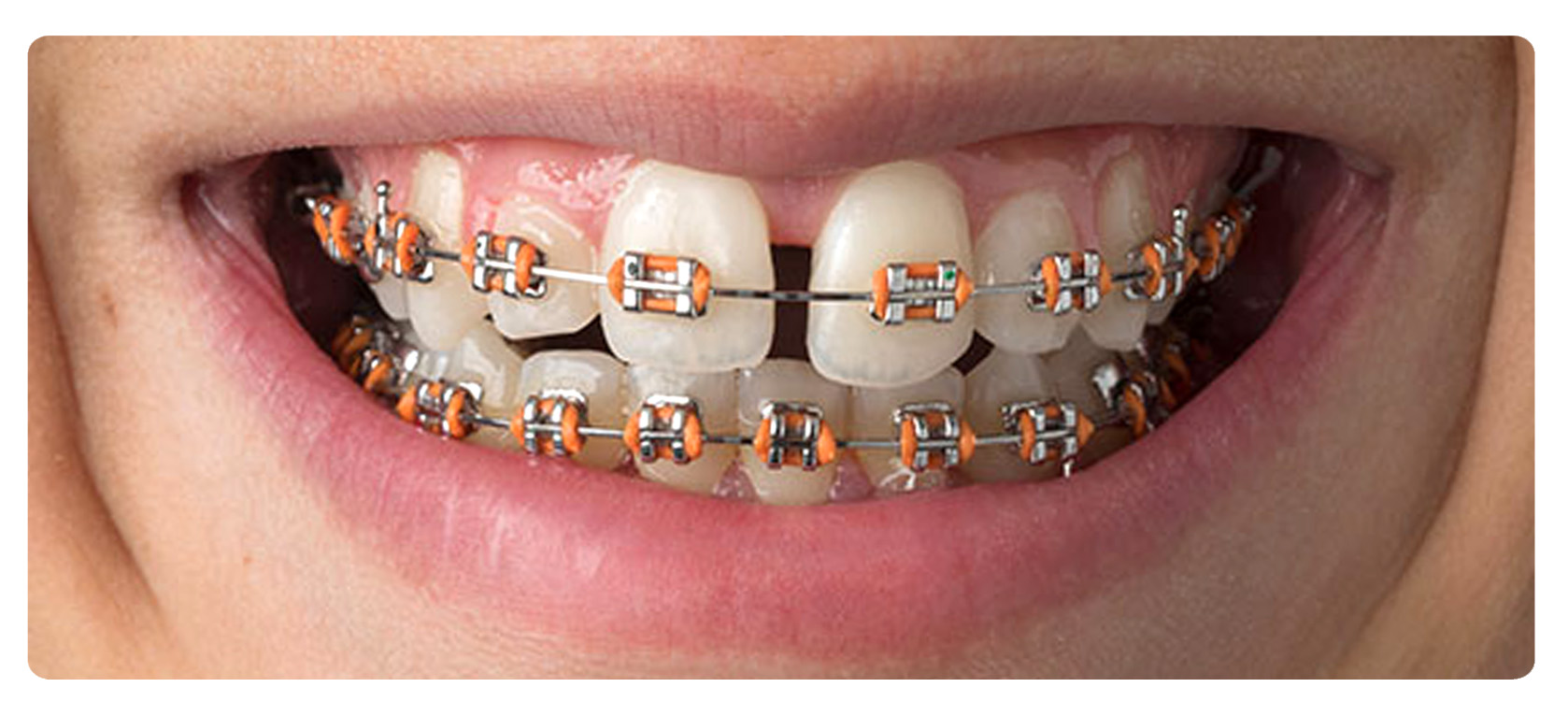 Consigli.. L'apparecchio ortodontico fisso - Studio Dentistico My